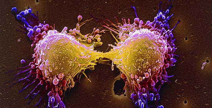 туморни клетки